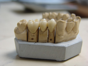 Протезування зубів, лікування і відновлення повністю або частково втрачених зубів - одна з важливих завдань сучасної стоматології